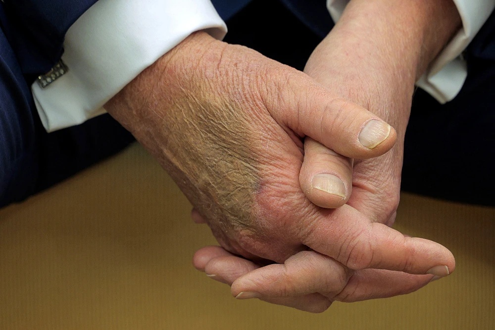 Trump Handbruises